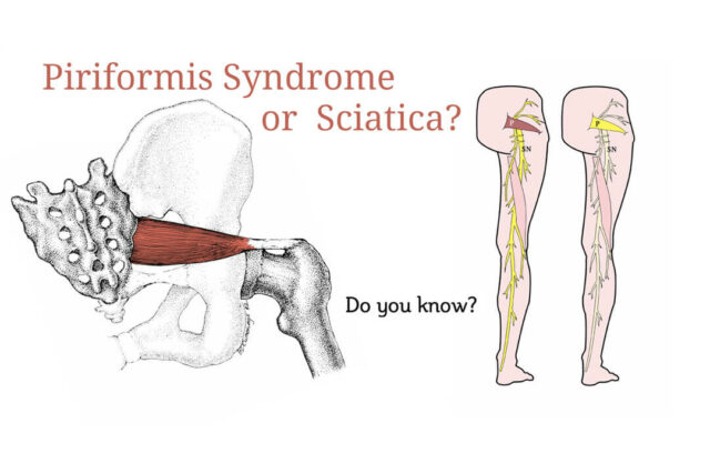 sciatica-or-piriformis-syndrome